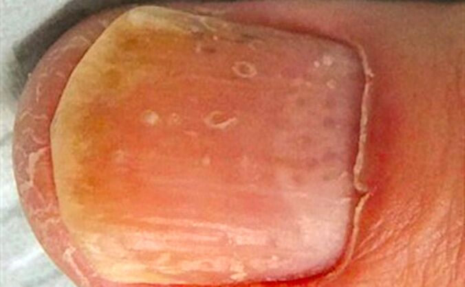 psoriasis-des-ongles-sur-les-mains-et-les-pieds-causes-diagnostic-et